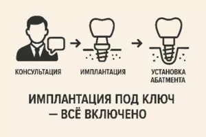 Имплантация зубов под ключ